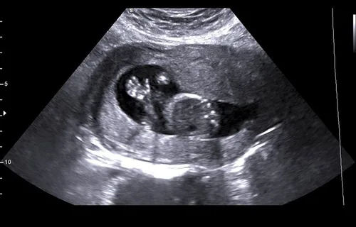 Early Pregnancy sample 1