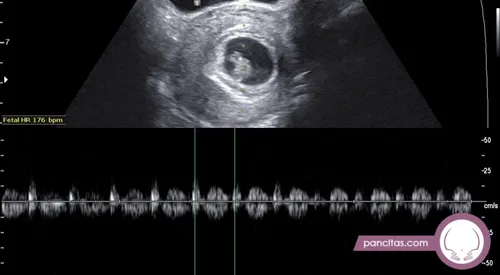Early Pregnancy sample 2