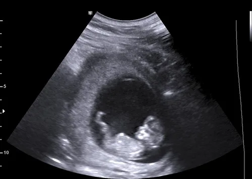 Early Pregnancy sample 3