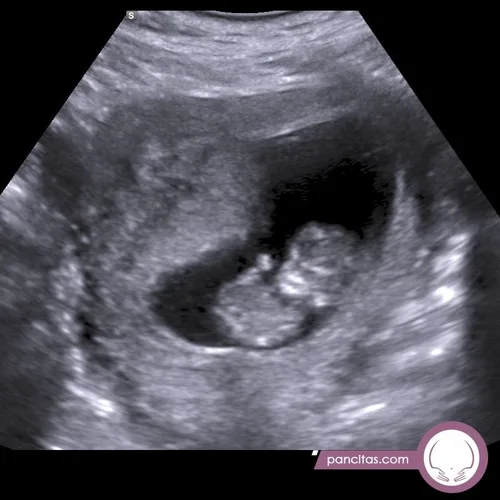Early Pregnancy sample 4
